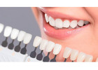 Porcelain Veneers with Durable and Natural Results