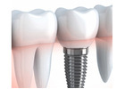 Dental Implant Surgery with Safe and Professional Care