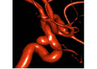 Advanced Neuro Care Through Aneurysm Brain Coiling