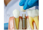 Tooth Implant Process Explained for Better Oral Health
