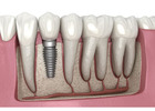 Dental Implants in Abbotsford | Permanent Tooth Replacement