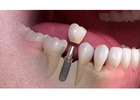 Dental Bridges in Abbotsford | Restore Missing Teeth Naturally