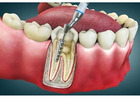 Root Canal Treatment Guide in Abbotsford | What You Need to Know