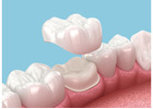 Dental Crown Cost and Types in Abbotsford: A Complete Guide