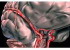 What Treatment Options Are Available for Stroke Hemorrhagic?